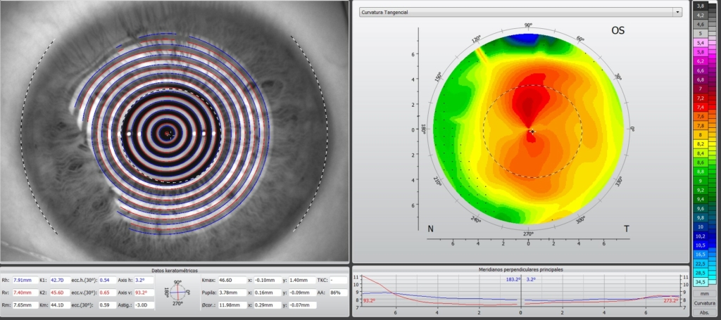 Resultados de análisis con topógrafo corneal en Asun Oliver Ópticas